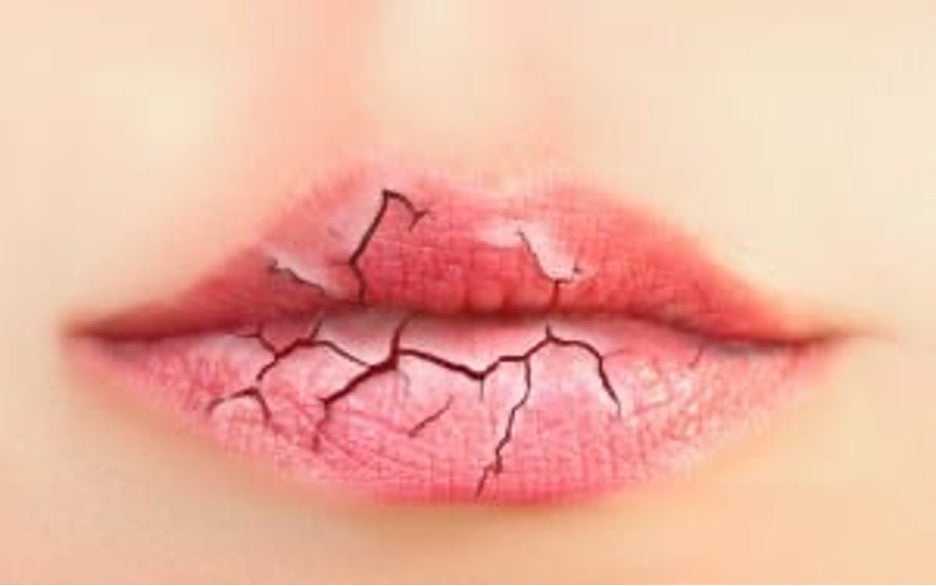 Chronic Chapped Lips: Cause, Effect and Solutions