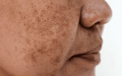 Melasma and Skin Discoloration: A Rising Epidemic