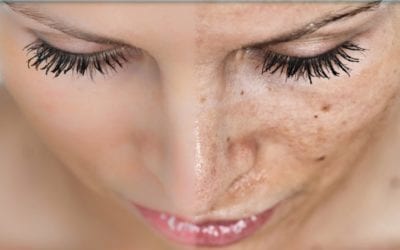 Photoaging: Solutions and Strategy for Hyperpigmentation and Sun Damaged Skin