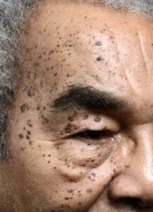 Skin Condition Dermatosis Papulosa Nigra (DPN)